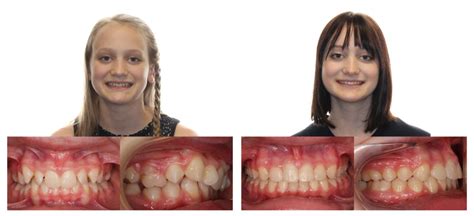 Before And After Austin Tx Rise Smile Orthodontics