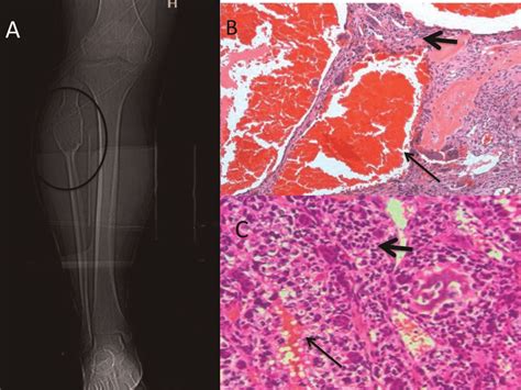 A Radiological Examination Of Telangiectatic Osteosarcoma Revealing A