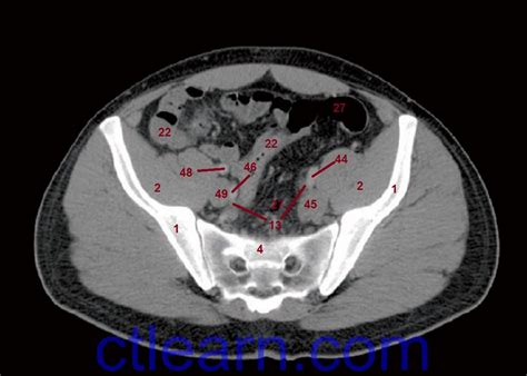 Ct Scan Abdomen And Pelvis Showing Axial View Of Cm Right Vulvar Hot