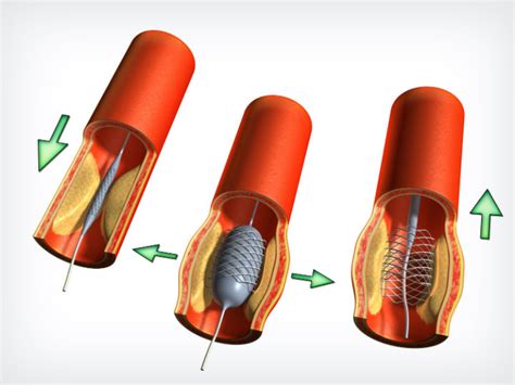 Angioplastia Y Colocación De Stent En Arterias Periféricas