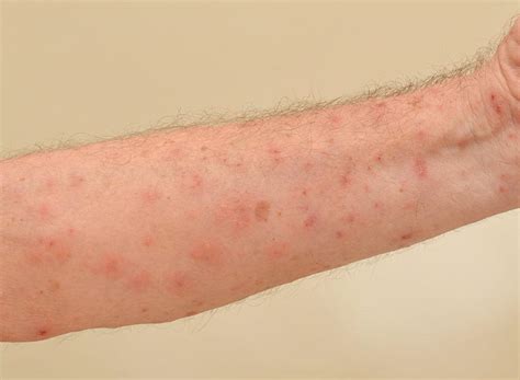 what causes scabies in nursing homes pintas and mullins law firm
