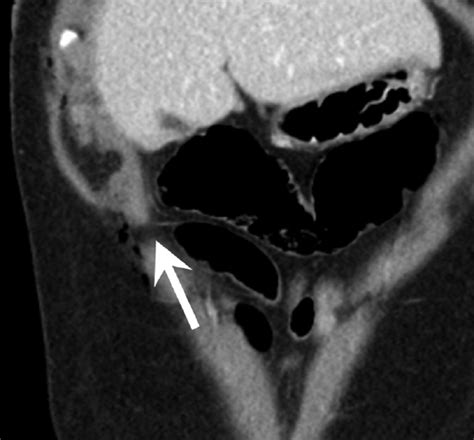 Traumatic Abdominal Wall Hernia • Applied Radiology