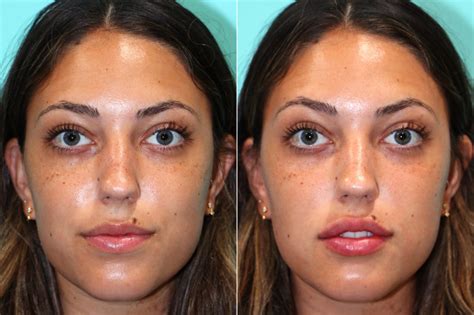 Lip Augmentation Photos Chevy Chase Md Patient 17568