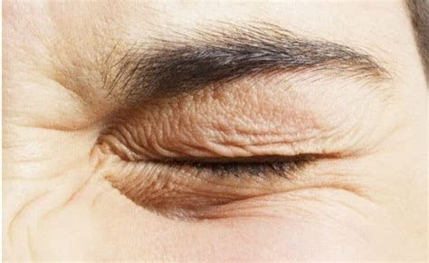 Eye Twitching Causes And How To Treat It Royal Spanish Center