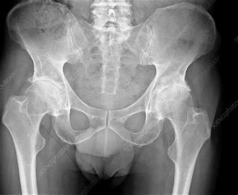 Osteoarthritis Of The Hips X Ray Stock Image C0169255 Science