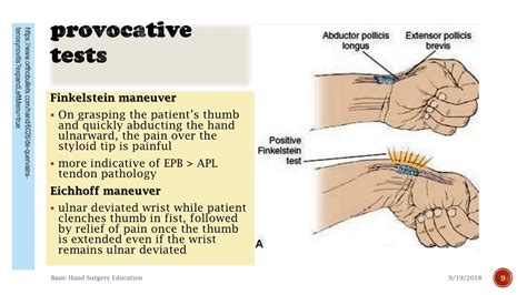 De Quervains Tenosynovitis Real Story Youtube