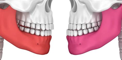 What Is Overbite And How Do You Correct It Braces Or Surgery