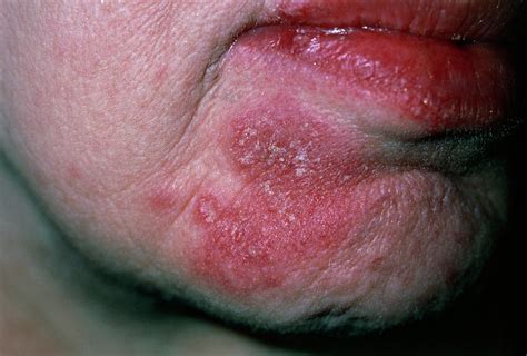 Facial Rash Of Systemic Lupus Erythematosus Sle Photograph By Dr P