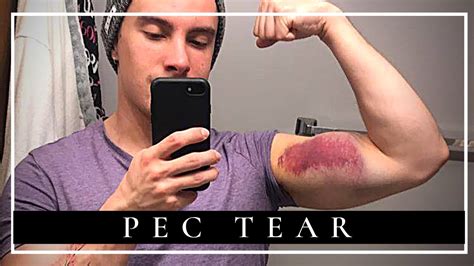 How I Recovered From Pec Tear Surgery In Only 4 Months Youtube