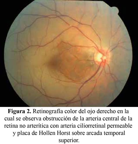 Obstrucción De Arteria Central De La Retina A Propósito De Un Caso
