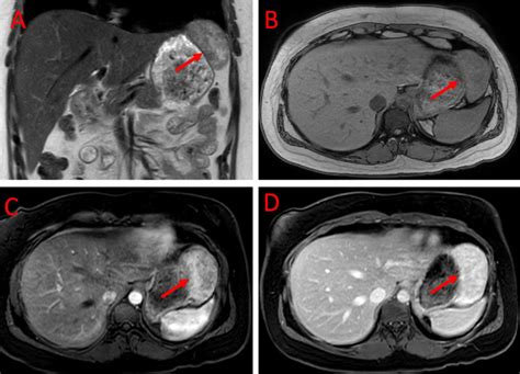 Mri Of The Abdomen With And Without Contrast A T2 Coronal Sequence