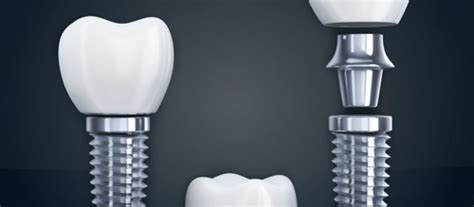Dental Implants 101 All The Basics You Need To Know 8118 Dental