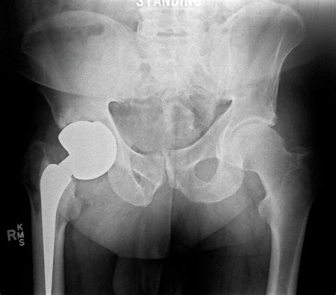 Failed Hip Replacement Photograph By Antonia Reevescience Photo Library Pixels