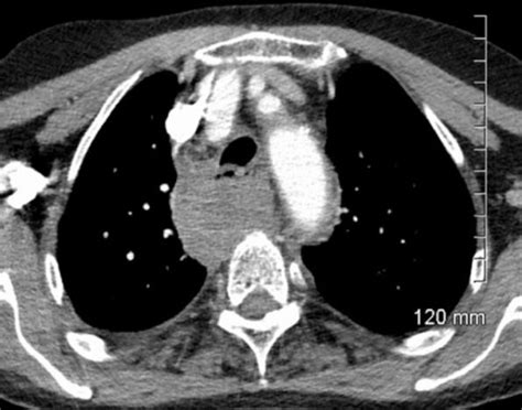 Intramural Oesophageal Haematoma Following Traumatic Neck Injury Bmj