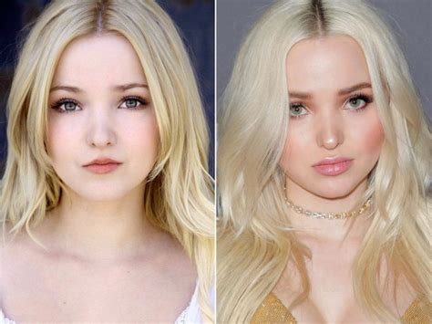 Dove Cameron Before And After Plastic Surgery Lip Surgery Dove Cameron