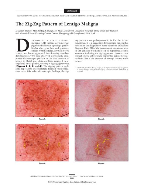 The Zig Zag Pattern Of Lentigo Maligna Dermatology Jama Dermatology