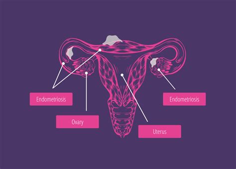 What Is Endometriosis Bucharest Endometriosis Center Drgabriel Mitroi