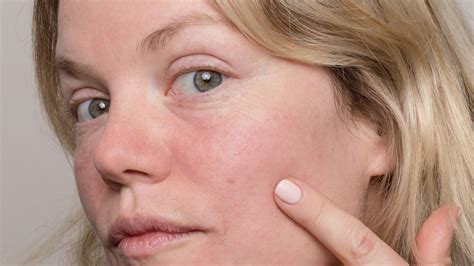 Treating Atrophic Acne Scars