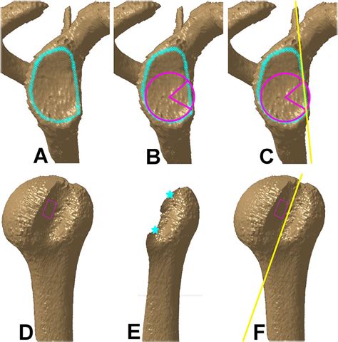 Identifying The Glenoid And Humeral Defect Axes A Selection Of