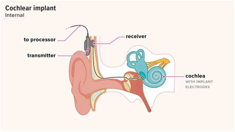 What Are Cochlear Implants And How Do They Work