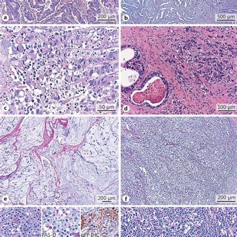 Heterogeneity Of Histopathological Classification Systems In Gastric