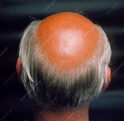 Bald Spot On Side Of Head