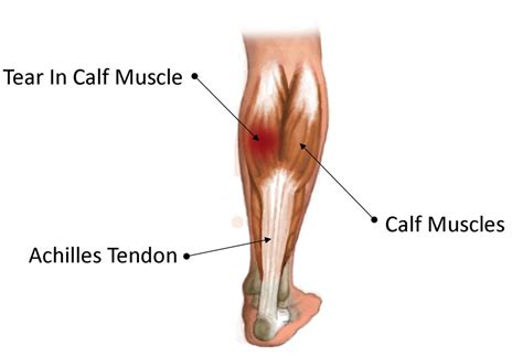 Wrist tendonitis is the inflammation of one or more tendons in the wrist. Common Lower Leg and Calf Injuries - My Family Physio