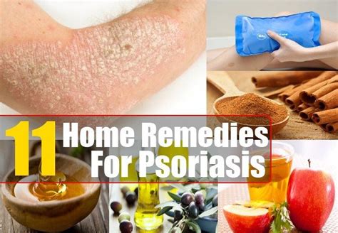 11 Home Remedies For Psoriasis Home Remedies For Psoriasis Psoriasis