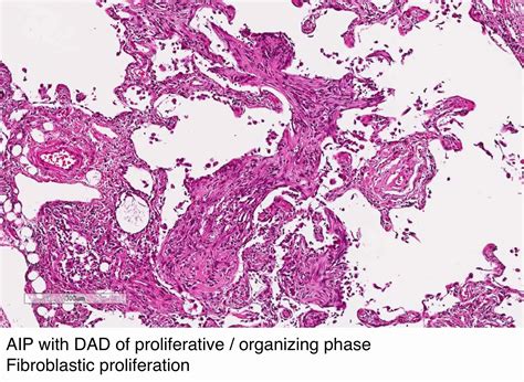 Pathology Outlines Acute Interstitial Pneumonia