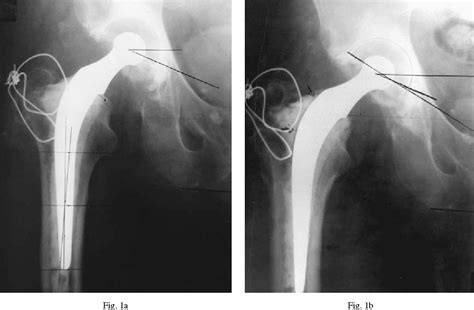 Figure 1 From Radiological Factors Influencing Femoral And Acetabular