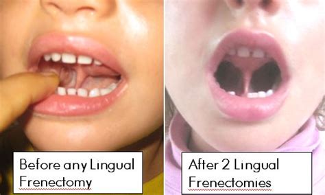 Lingual Frenectomy Before After Debug Your Health