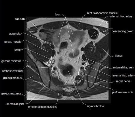 Pelvis Muscles Mri Anatomy The Pelvis Radiology Key Functional