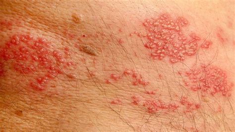 Common Types Of Rashes Everyday Health Skin Rash Itchy Skin