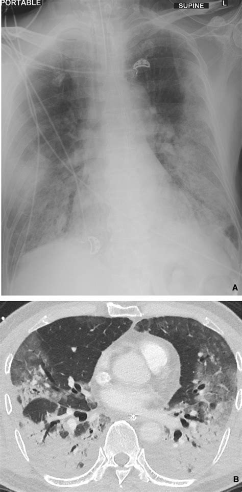A Portable Supine Cxr Shows Intubated Patient With Mixed Ground Glass