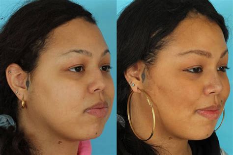 Buccal Fat Removal Chicago Il Dr Anil Shah