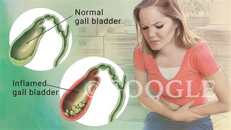 Gall Bladder Disease Illustration By Michele Graham Medical