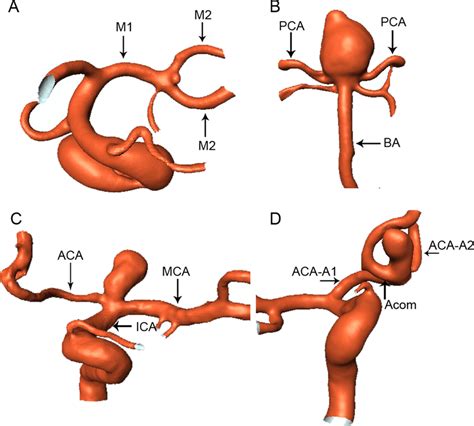 Aneurysms Are Shown At The Bifurcations Of The Middle Cerebral Artery Download Scientific