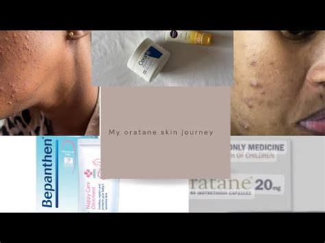 How I Cleared My Acne With Oratane Side Effects Cost More Oratane Cerave Nivea YouTube