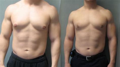 How To Tell If You Have Gynecomastia Or Not Youtube