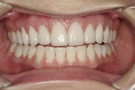 Before And After Porcelain Veneers And Smile Makeover Photos