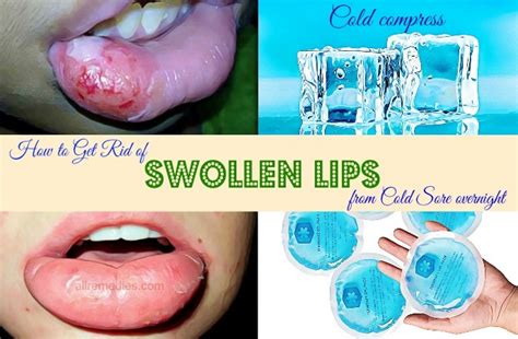 20 Tips How To Get Rid Of Swollen Lips From Cold Sore Overnight
