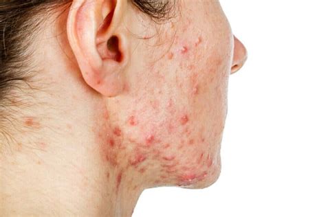 Nodular Acne Everything You Need To Know
