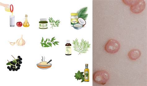 Tratamento Complementar Para Molusco Contagioso