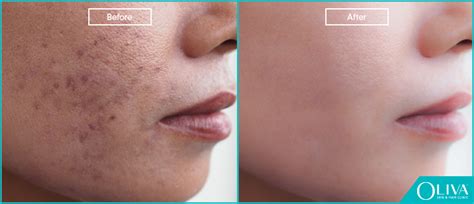 Skin Spots Treatment Before And After Your Magazine Lite