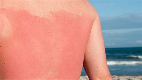 Man S Sunburn Is Going Viral Reminds Us The Importance Of Sunscreen Allure