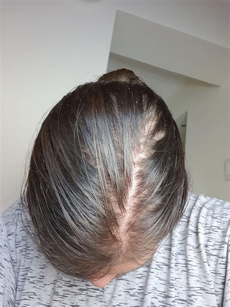 Is My Hair Thinning Is This Normal Im Worried What Should I Do About