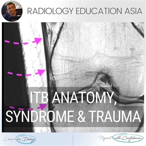 Iliotibial Band Mri Anatomy Syndrome Trauma Knee Radiology Radedasia