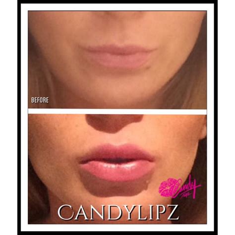 Natural Lip Fillers Outrageous Before And After Photos 4 Candylipz