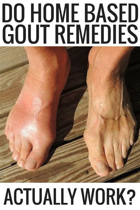 Do Home Based Gout Remedies Actually Work Gout Remedies How To Get Rid