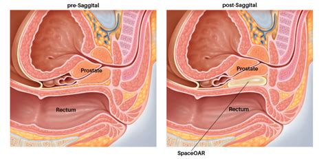 Spaceoar Hydrogel Prostate Cancer Radiation Therapy